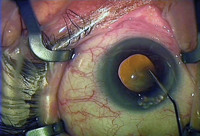 unequal pupil size after cataract surgery unequal pupil size after cataract surgery