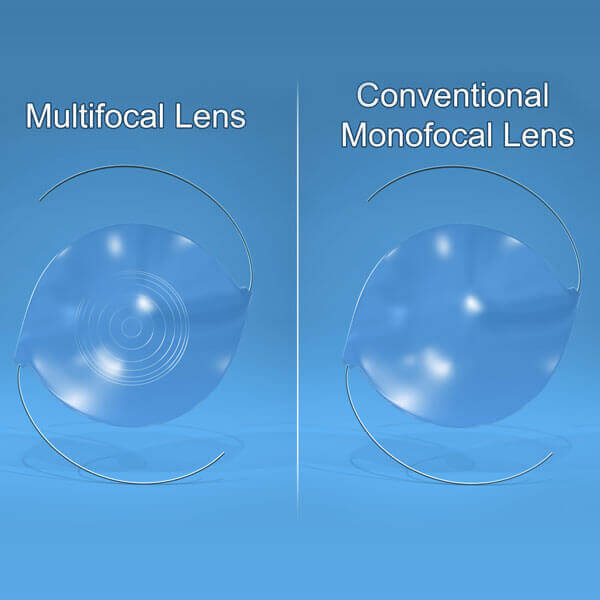 Comparison of Multifocal and Conventional Monofocal Lens